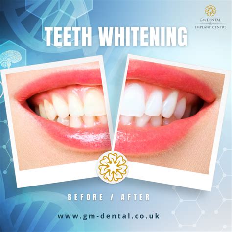 tooth implant in ashford|Dentist Near Me In Ashford, Kent Dental Implants, Invisalign & More.